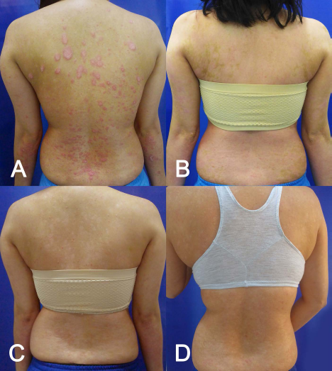 (圖2A）基線（細(xì)胞移植前)；(圖2B）首次輸注后 30 天；(圖C2) 121 天后；(圖2D）231 天后。