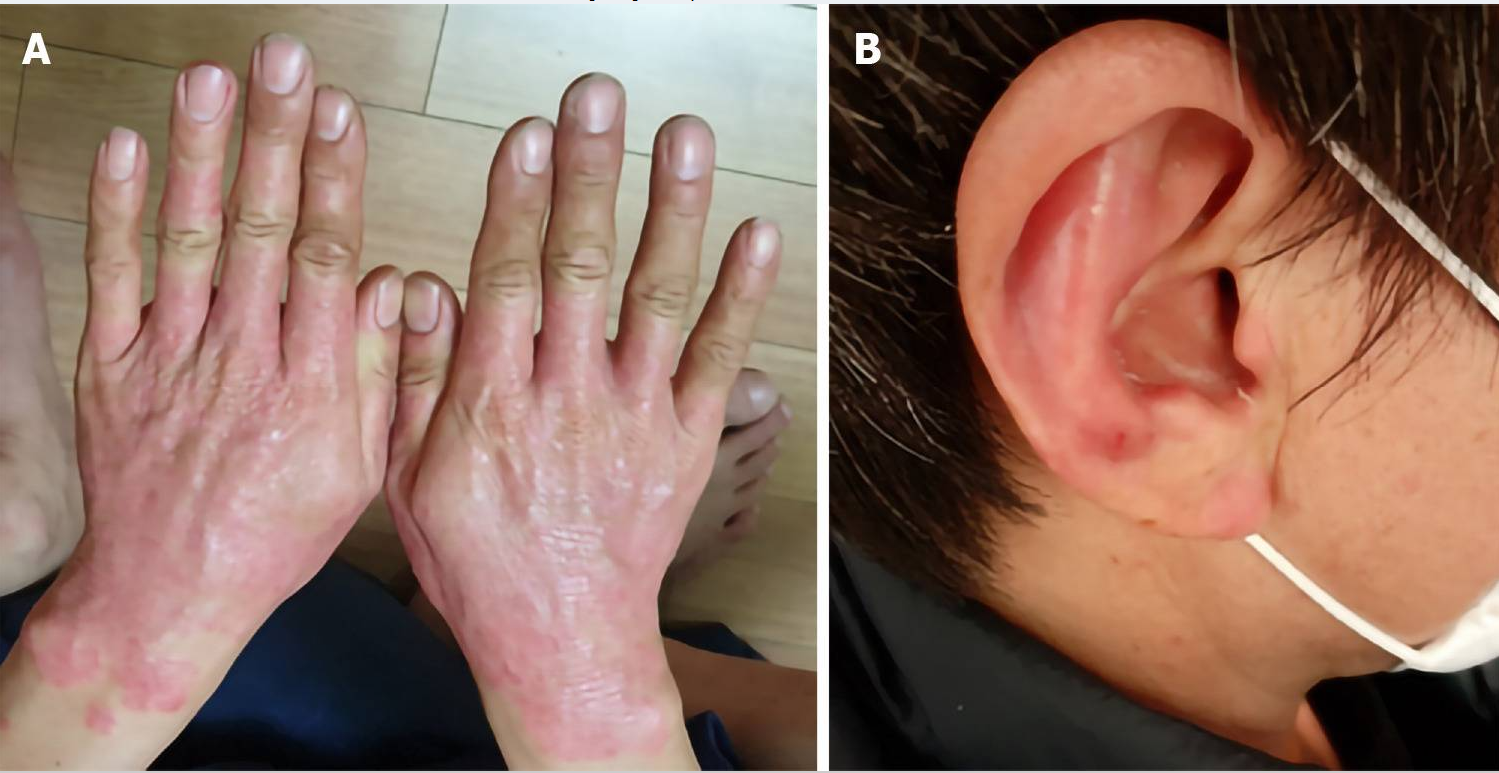 治療前銀屑病病變部位