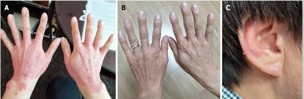 治療后銀屑病病變部位