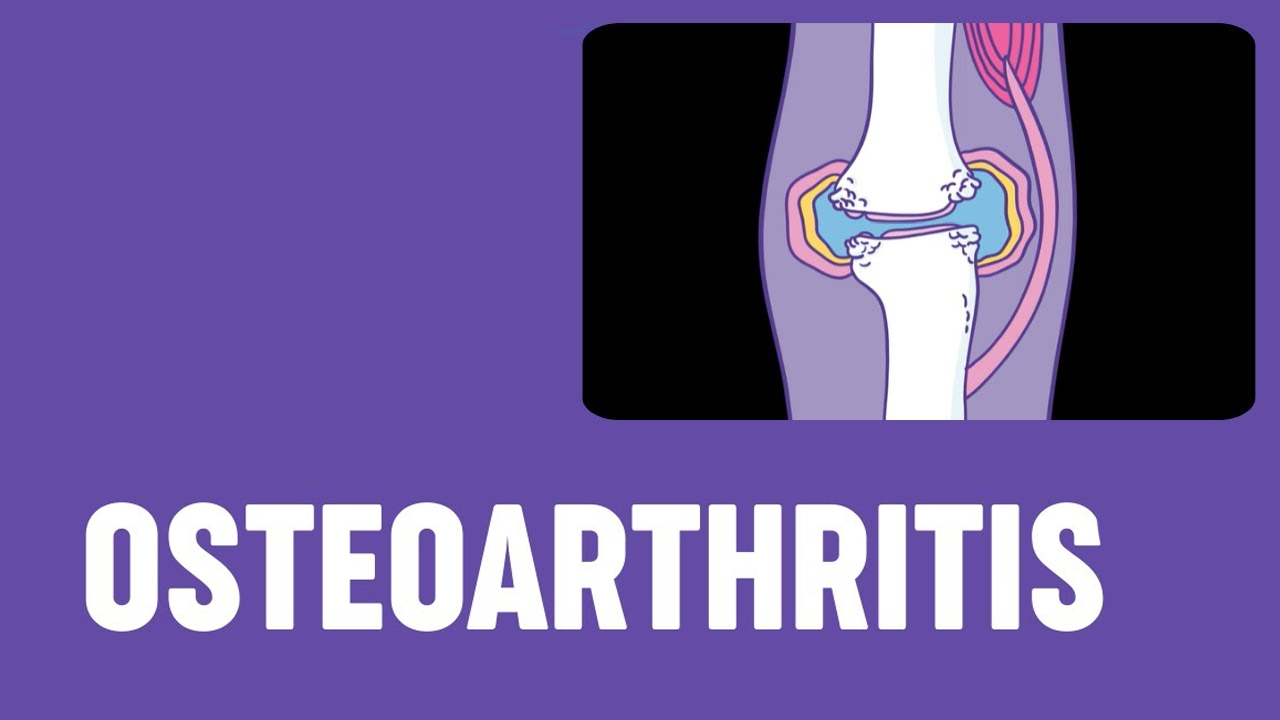 5項(xiàng)研究171例患者，評(píng)估干細(xì)胞治療骨關(guān)節(jié)炎的安全性和有效性