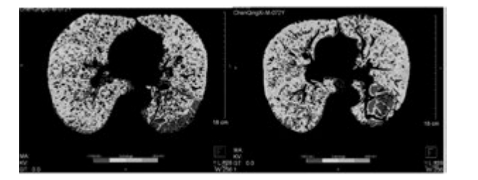 雙源CT肺實質(zhì)分析軟件