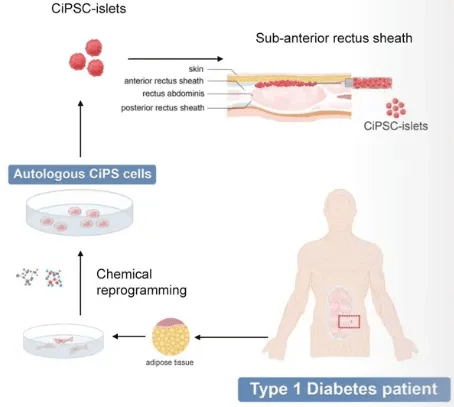 干細(xì)胞技術(shù)將成為糖尿病治療的新里程碑