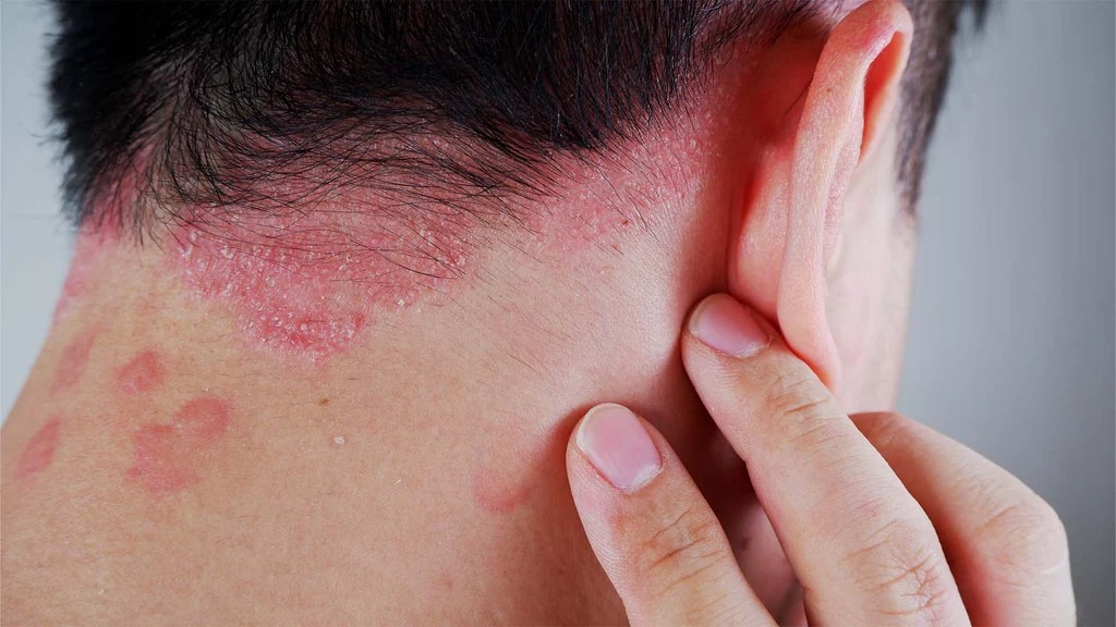 銀屑病如何治療？干細(xì)胞療法如何為銀屑病患者掃除障礙？