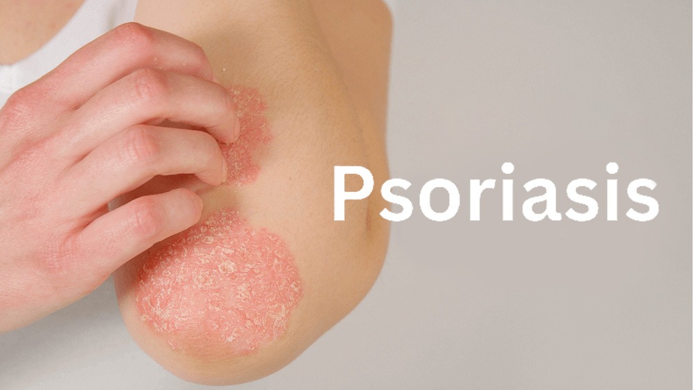 銀屑病治療新篇章：盤點(diǎn)2020-2024年干細(xì)胞治療銀屑病臨床研究進(jìn)展