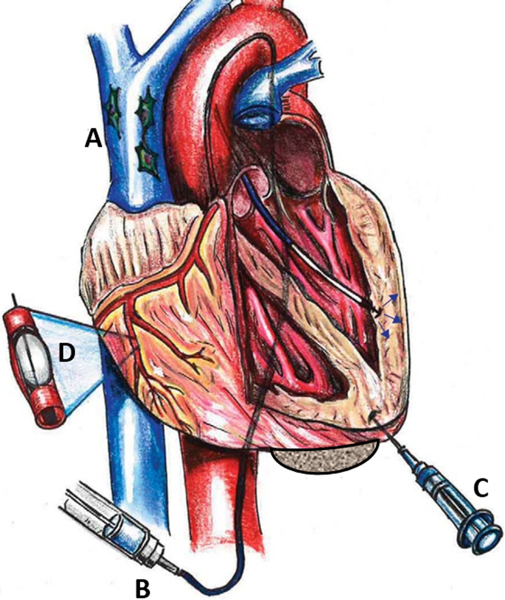 圖1：MSC通過系統(tǒng) (Sys) 和局部 (Loc) 途徑進入心臟。