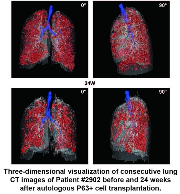 患者#2902在自體P63+細(xì)胞移植前后24周連續(xù)肺部CT圖像的三維可視化。
