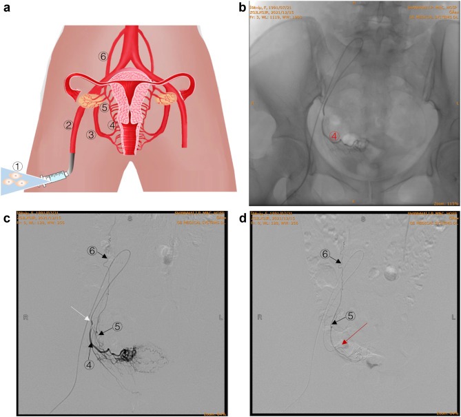 圖 2：通過卵巢?動脈精確輸注 hAEC。