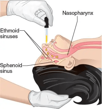 干細胞輸送方法有13種，其中干細胞移植的過程都是什么樣的？
