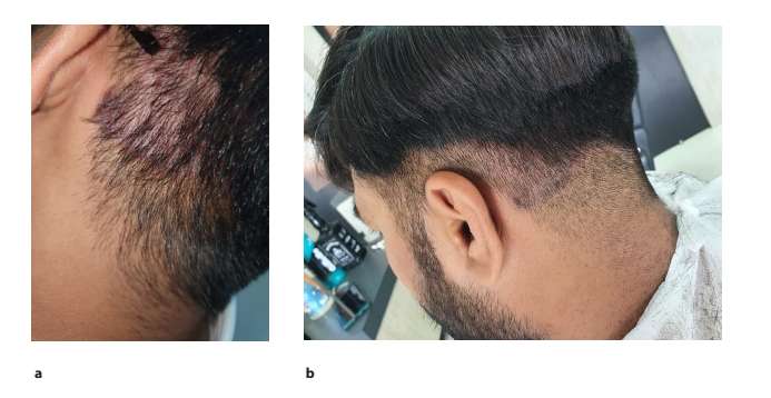 圖2.患者枕部頭皮銀屑病治療后圖像2周(a)和4周(b)頭皮銀屑病治療后鱗屑和斑塊減少的隨訪圖像。