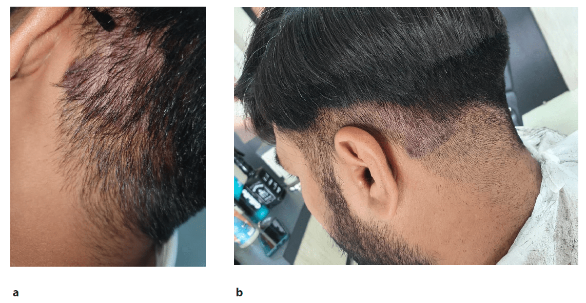圖2：患者頸部枕部下方頭皮牛皮癬治療后圖像，治療后2周（a）和4周（b）隨訪時頭皮牛皮癬銀色鱗片和斑塊減少