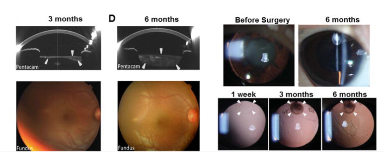 手術(shù)后六個月，囊袋充滿了再生晶狀體組織