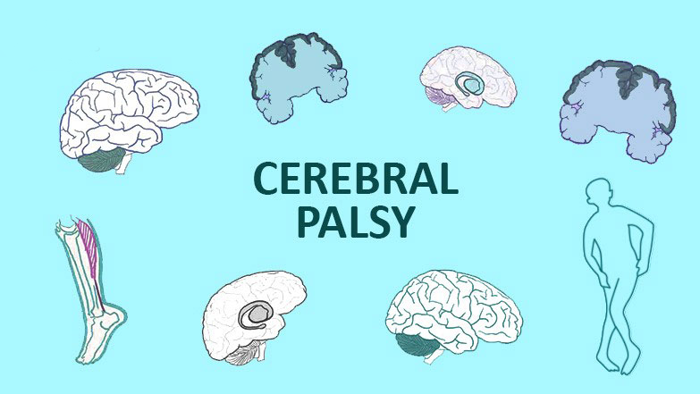 從步履蹣跚到穩(wěn)健行走：干細胞技術如何重塑腦癱兒童平衡能力？