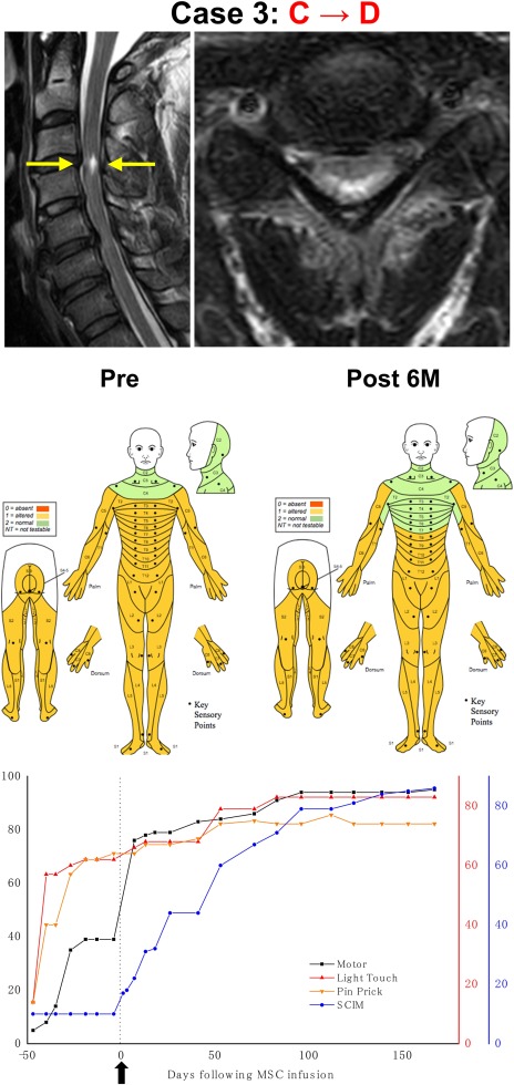 干細胞治療后患者的恢復(fù)狀態(tài)圖 干細胞治療后患者的恢復(fù)狀態(tài)圖
