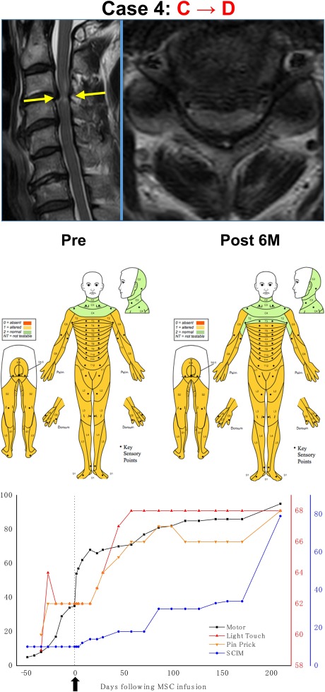 干細胞治療后患者的恢復(fù)狀態(tài)圖 干細胞治療后患者的恢復(fù)狀態(tài)圖