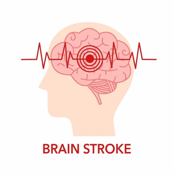 直擊腦卒中：神經(jīng)干細(xì)胞移植的治療方法有哪些？