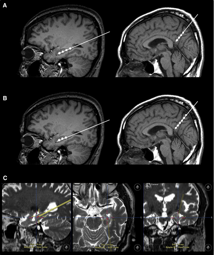臍帶間充質(zhì)干細胞的立體定向給藥 臍帶間充質(zhì)干細胞的立體定向給藥