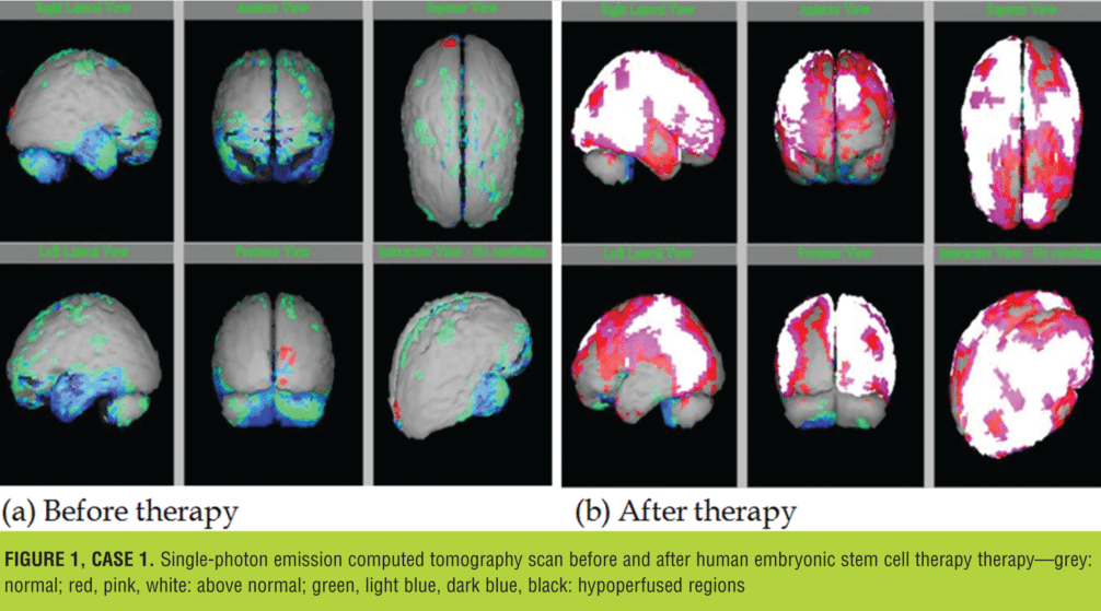 圖 1 為患者第二次治療前后的 SPECT 掃描圖像