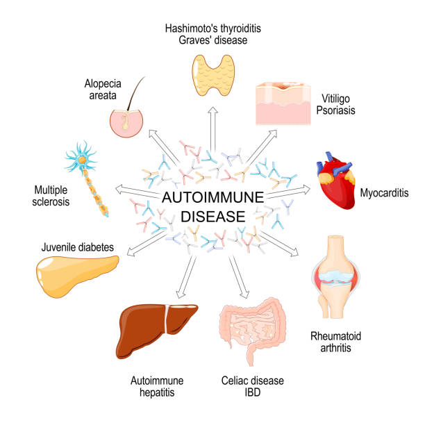 間充質(zhì)干細(xì)胞療法：一種在10種自身免疫性疾病中有前景的治療方法