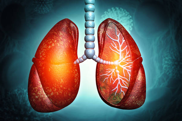 間充質(zhì)干細胞治療4大類肺部疾病的臨床試驗進展及挑戰(zhàn) 間充質(zhì)干細胞治療4大類肺部疾病的臨床試驗進展及挑戰(zhàn)