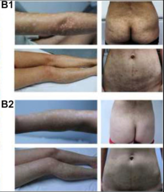 患者二治療前后對(duì)比圖