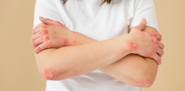 干細(xì)胞治療系統(tǒng)性紅斑狼瘡：如何實(shí)現(xiàn)從短期的疾病癥狀緩解到長(zhǎng)期的多器官功能改善？