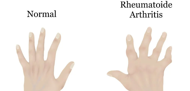 干細(xì)胞治療類風(fēng)濕關(guān)節(jié)炎：如何實(shí)現(xiàn)從短期關(guān)節(jié)功能改善到長(zhǎng)期的生活質(zhì)量提升？