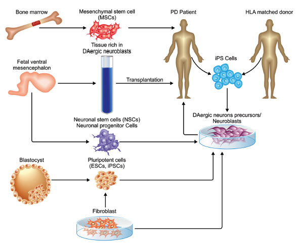 圖 (1)。不同類型的干細(xì)胞可用于帕金森病的修復(fù)。
