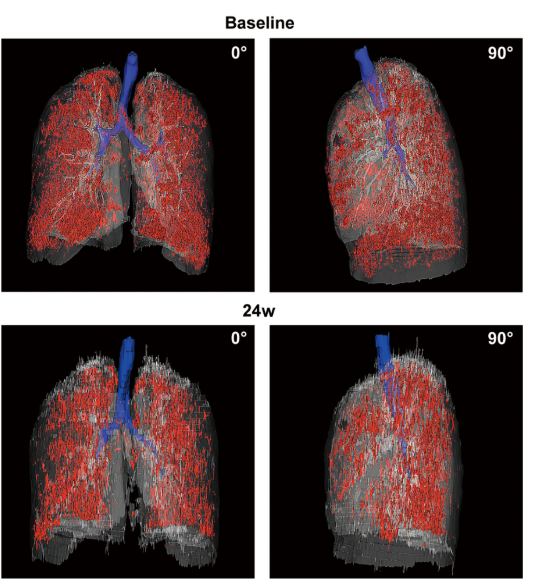 患者 #2902 自體 P63 細(xì)胞移植前和后 24 周連續(xù)肺部 CT 圖像的三維可視化。