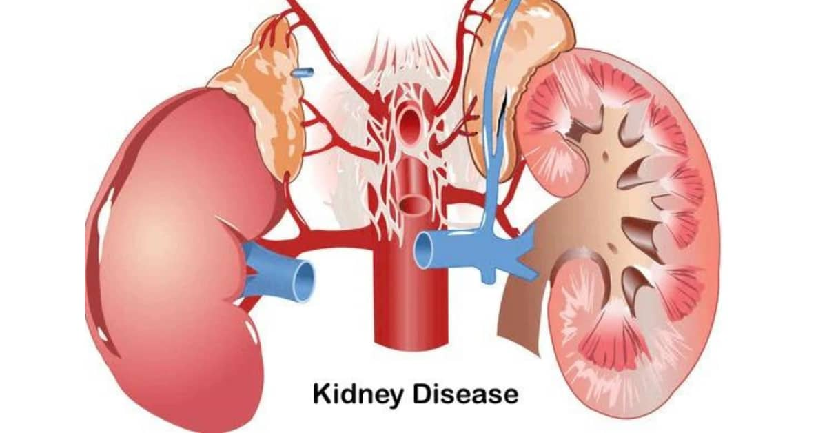 干細(xì)胞治療腎?。红o脈、動(dòng)脈、皮質(zhì)注射哪種更安全