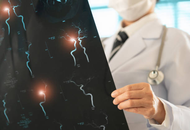 骨髓干細胞治療缺血性卒中靠譜嗎？網(wǎng)絡薈萃分析給出答案