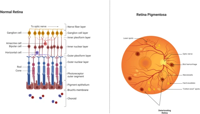 圖6：正常視網(wǎng)膜與受視網(wǎng)膜色素變性影響的視網(wǎng)膜的比較。