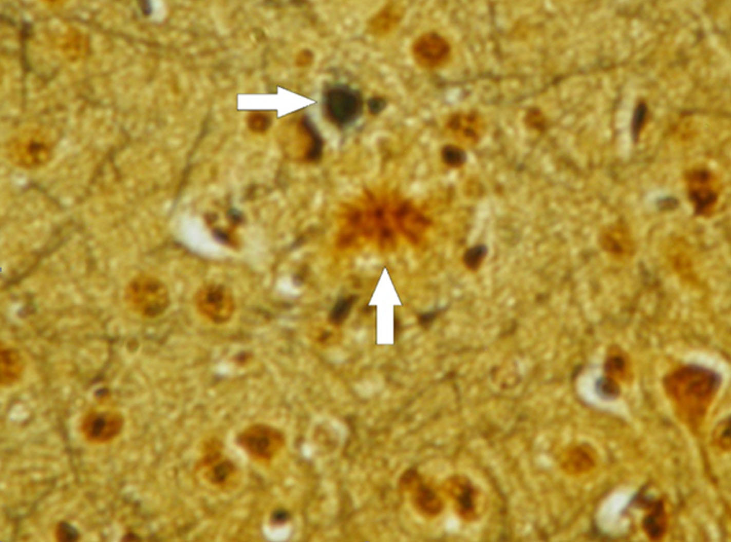 圖4：本圖描繪了三重轉(zhuǎn)基因小鼠模型中阿爾茨海默病的病理特征。