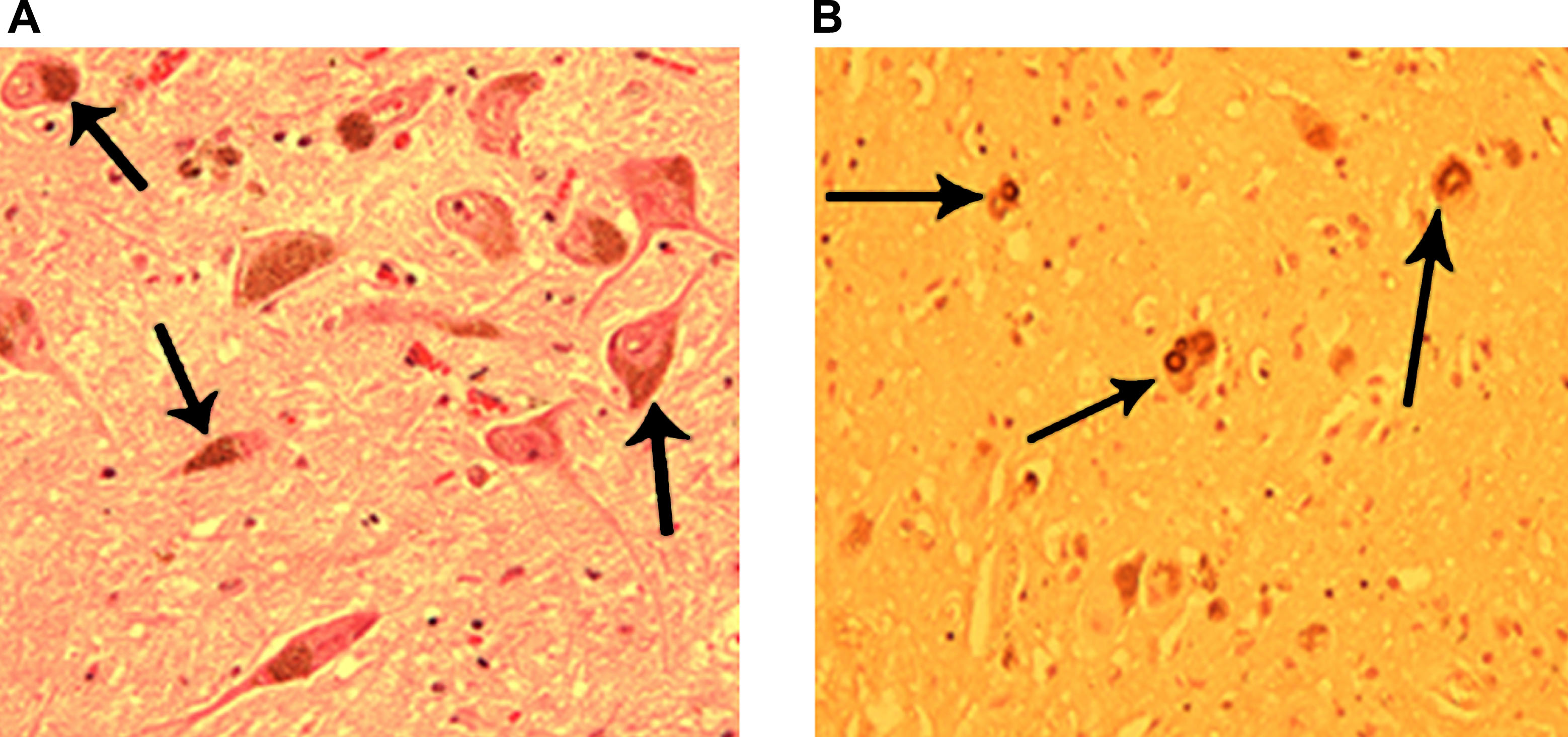 圖3：正常和帕金森病患者的黑質(zhì)。