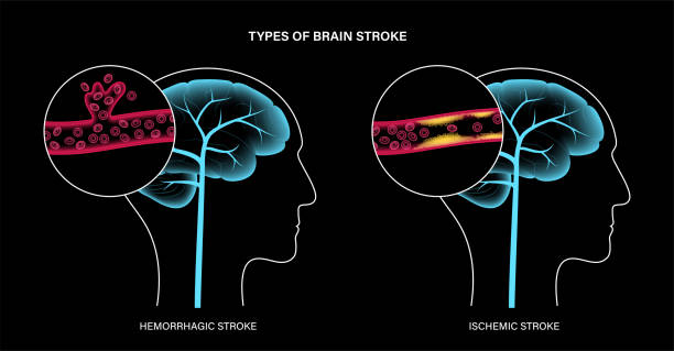 從癱瘓到復(fù)??！神經(jīng)干細(xì)胞療法5大機(jī)制如何促進(jìn)中風(fēng)后的大腦修復(fù)？