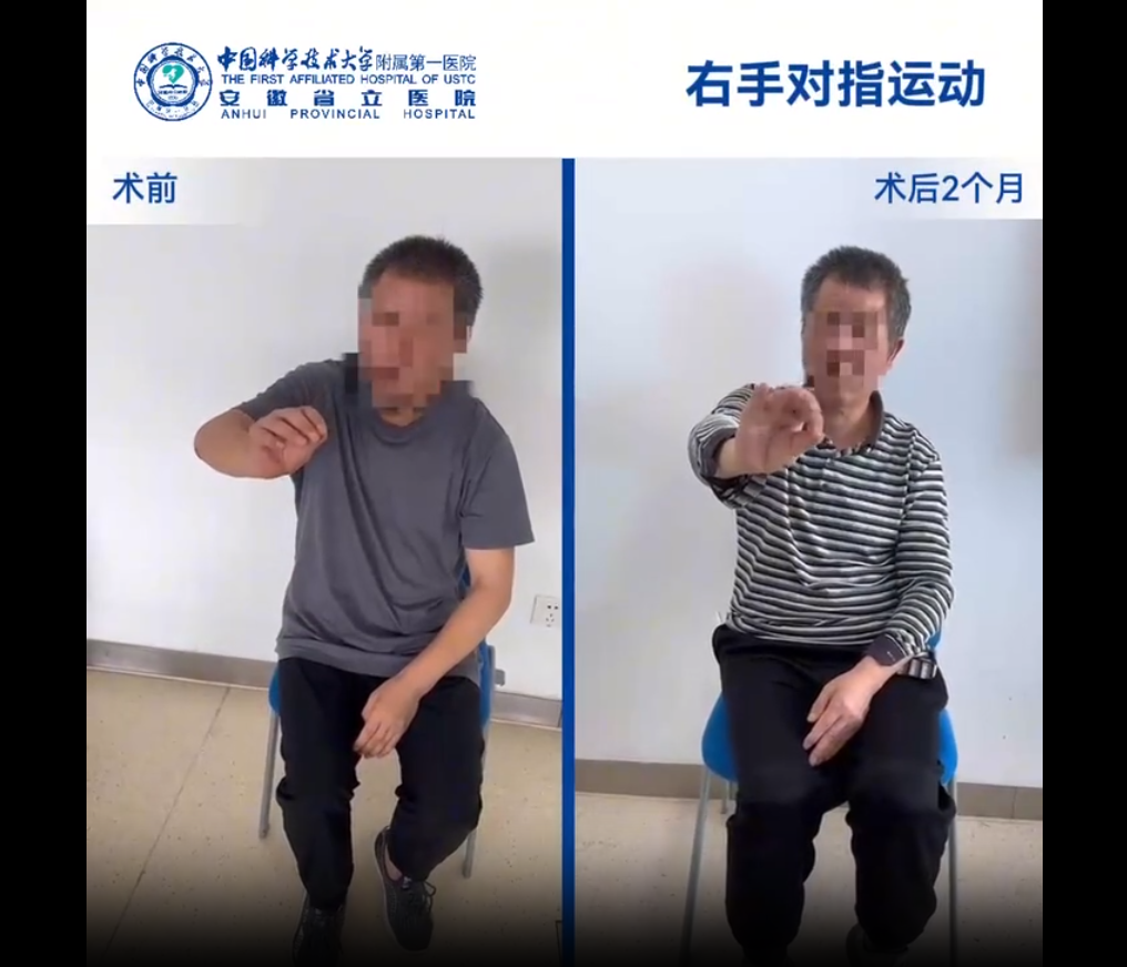 國內(nèi)誘導(dǎo)多能干細(xì)胞療法新突破：首例早發(fā)型帕金森病成功給藥，當(dāng)天即可行走