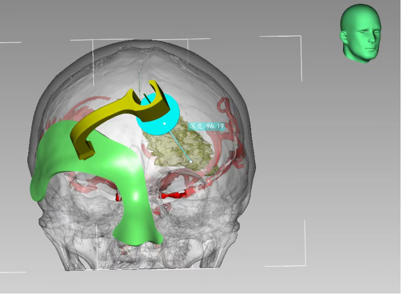 3D打印技術(shù)定位下腦內(nèi)血腫穿刺術(shù) 3D打印技術(shù)定位下腦內(nèi)血腫穿刺術(shù)