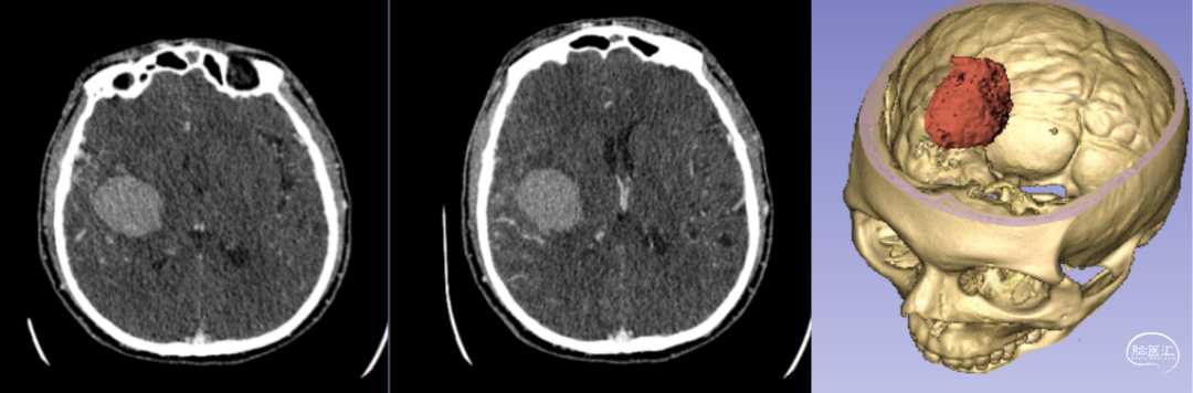 神經(jīng)外科手術(shù)機器人輔助下腦內(nèi)血腫穿刺術(shù) 神經(jīng)外科手術(shù)機器人輔助下腦內(nèi)血腫穿刺術(shù)