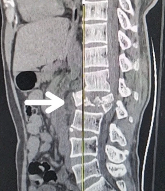 圖1：X射線(xiàn)圖像顯示脊髓損傷，椎骨骨折和移位，如白色箭頭所示