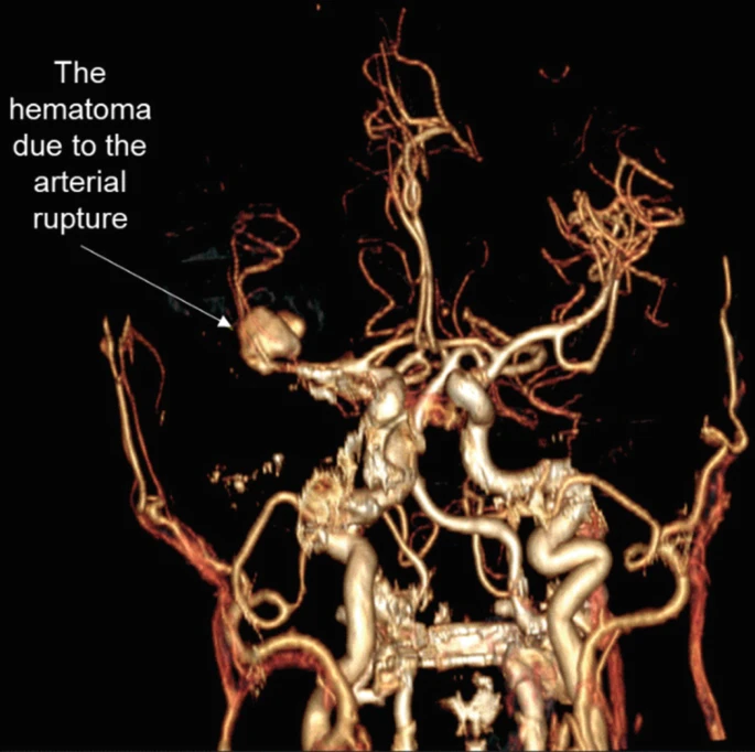 圖2:出血導(dǎo)致中風(fēng) 圖2:出血導(dǎo)致中風(fēng)