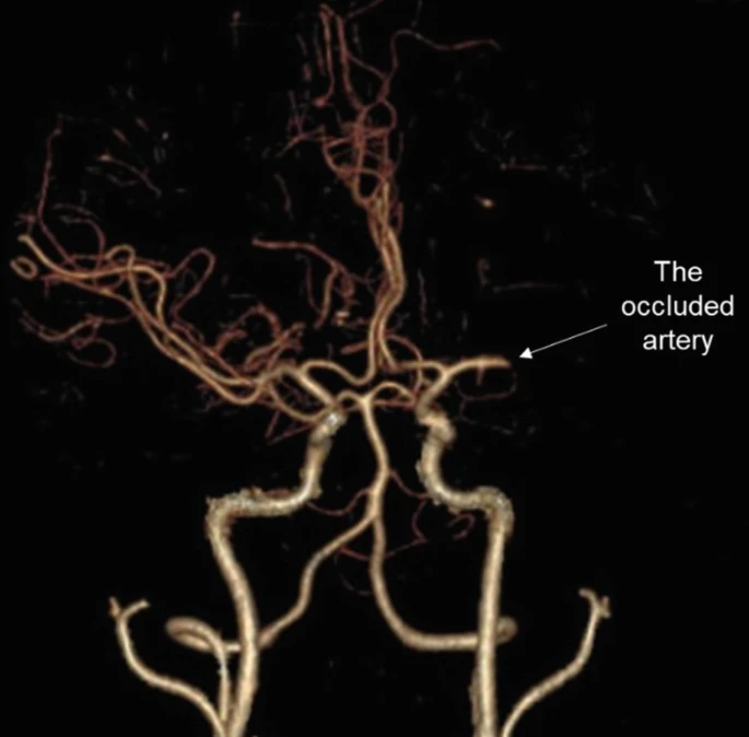 圖1:動脈閉塞導(dǎo)致的缺血性中風(fēng) 圖1:動脈閉塞導(dǎo)致的缺血性中風(fēng)