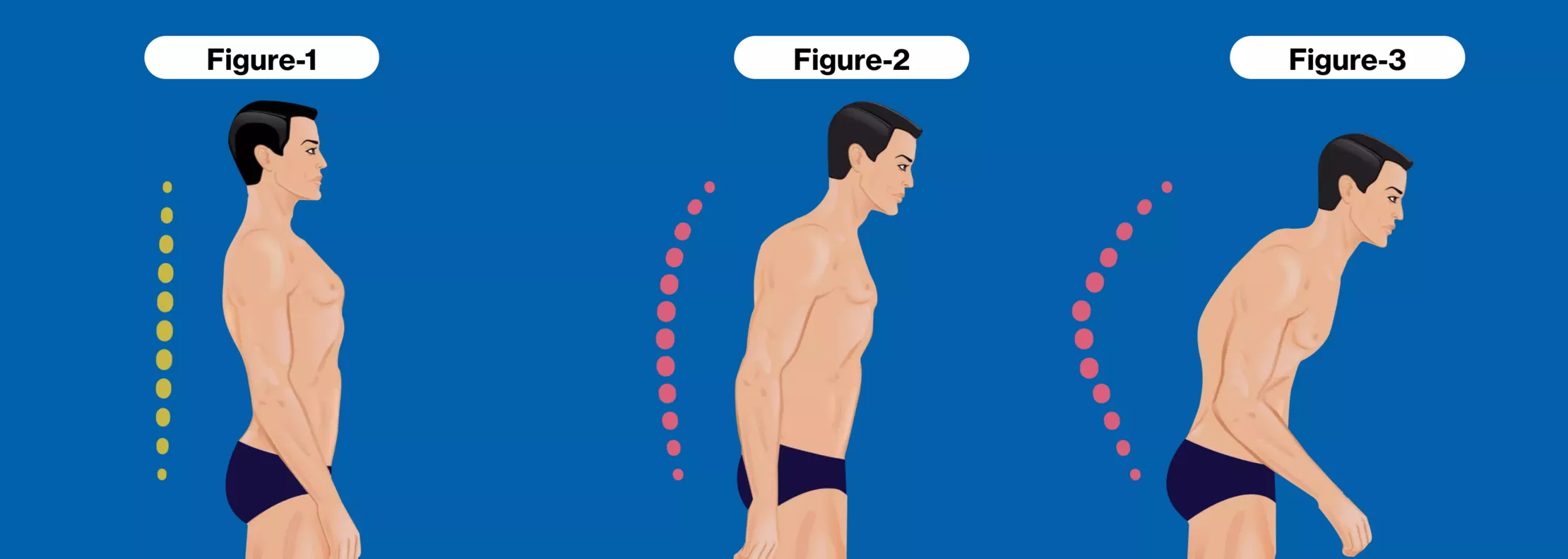 2025強直性脊柱炎治療指南：5種最新治療方法的臨床突破