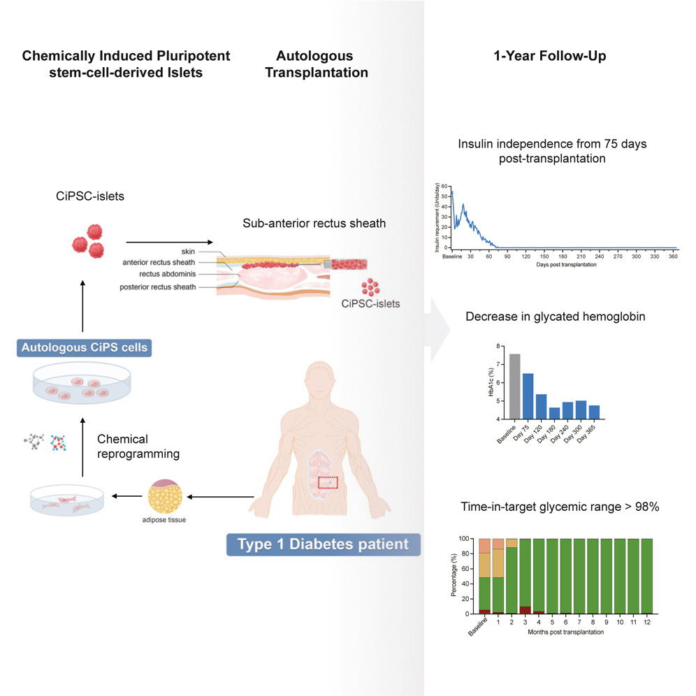 化學(xué)誘導(dǎo)多能干細胞衍生的胰島自體移植一年隨訪