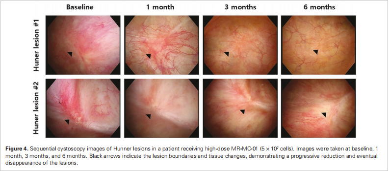 間質(zhì)性膀胱炎臨床試驗 間質(zhì)性膀胱炎臨床試驗