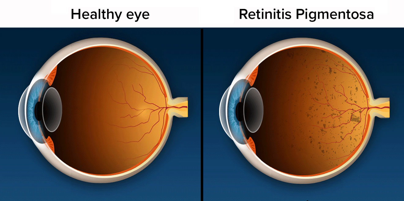 視網(wǎng)膜色素變性 視網(wǎng)膜色素變性
