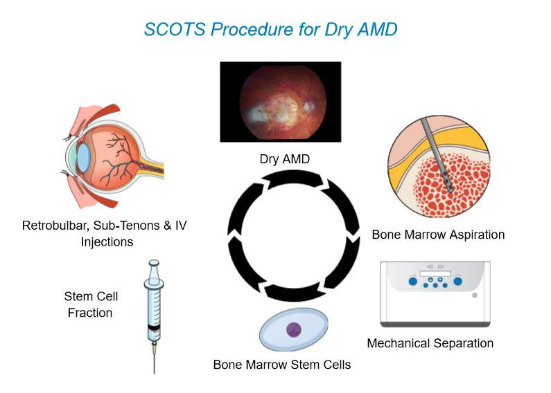 干細(xì)胞治療年齡相關(guān)黃斑變性 干細(xì)胞治療年齡相關(guān)黃斑變性