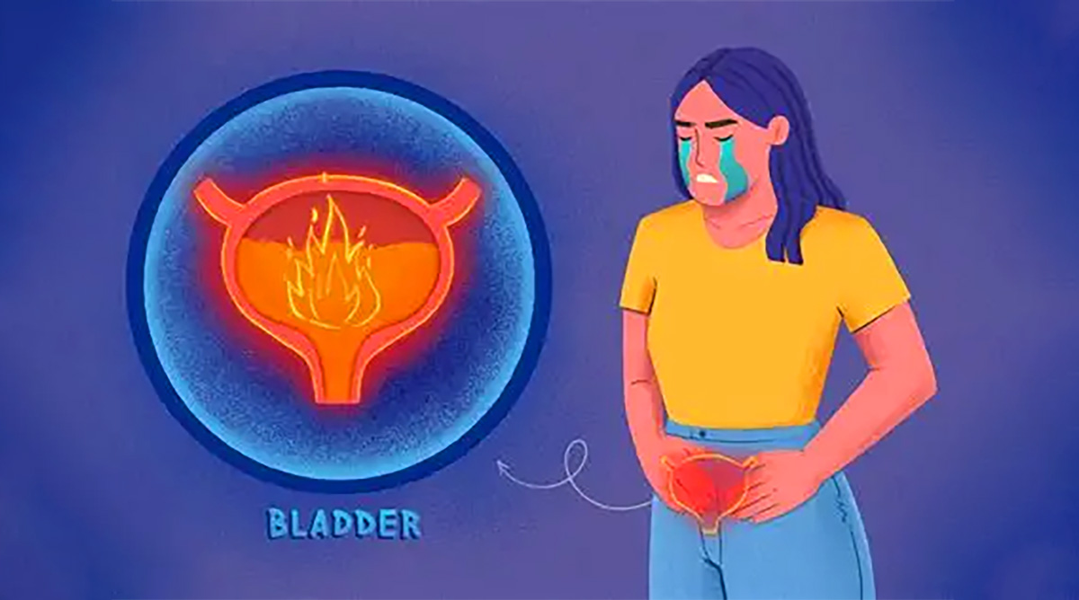 間質(zhì)性膀胱炎 間質(zhì)性膀胱炎