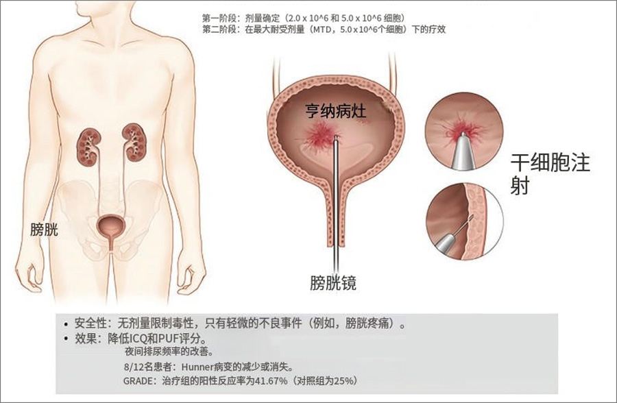 干細(xì)胞治療 干細(xì)胞治療
