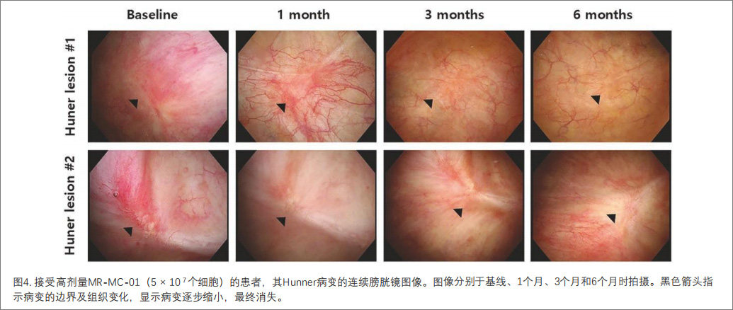 間質(zhì)性膀胱炎臨床試驗(yàn) 間質(zhì)性膀胱炎臨床試驗(yàn)