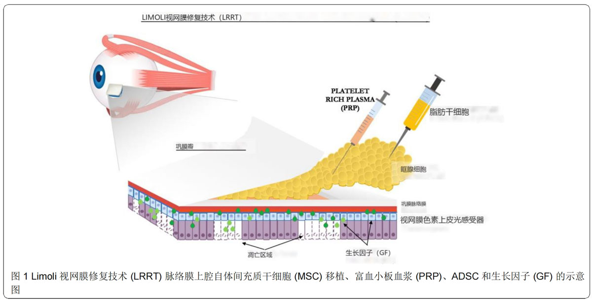 青光眼臨床試驗 青光眼臨床試驗