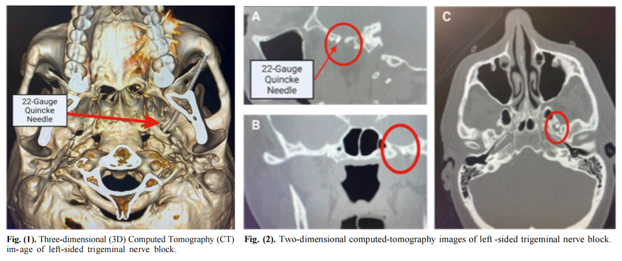 三叉神經(jīng)痛臨床試驗 三叉神經(jīng)痛臨床試驗